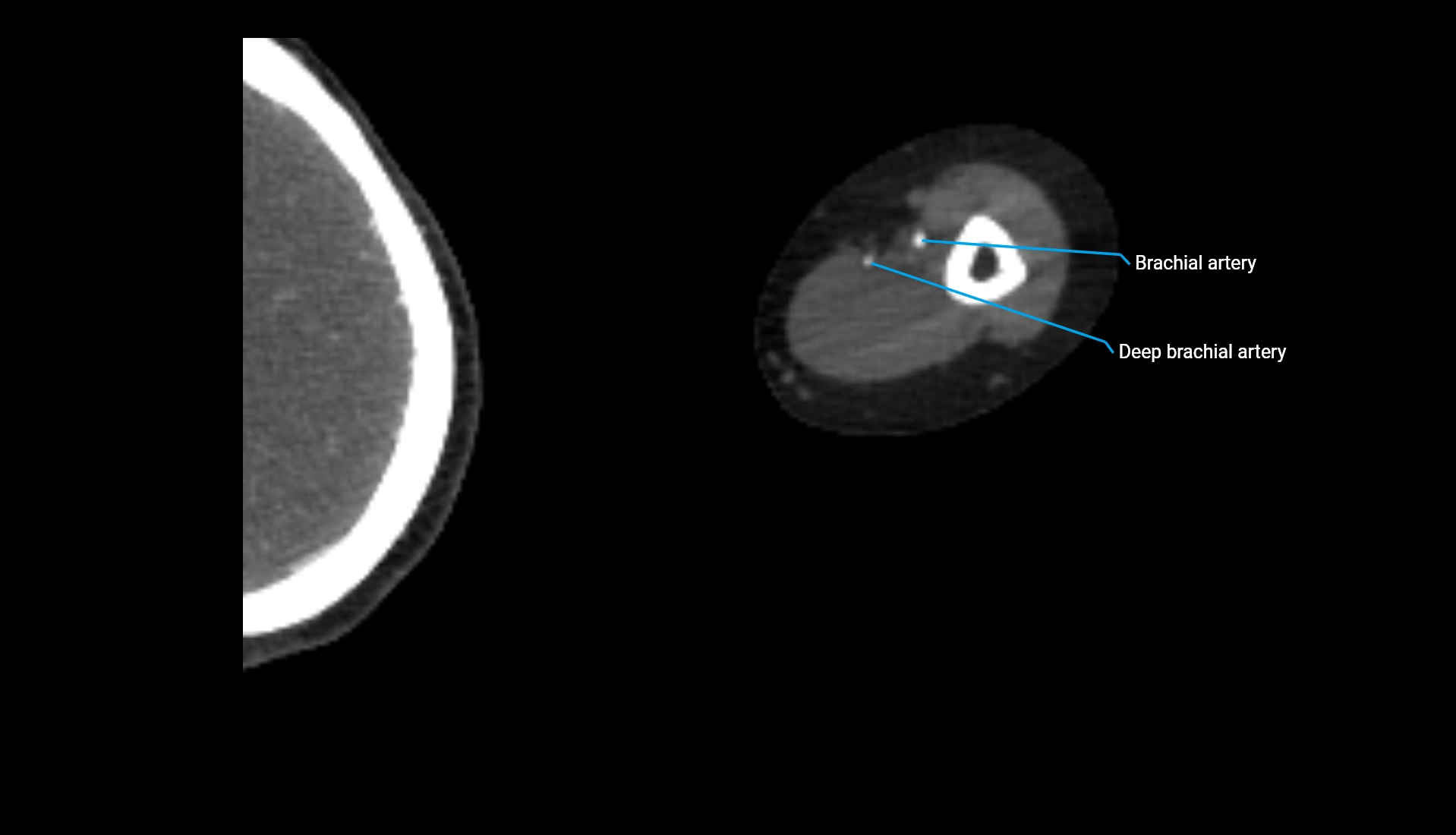 CTA upper limb axial cross sectional anatomy labelled image 225 (2).webp